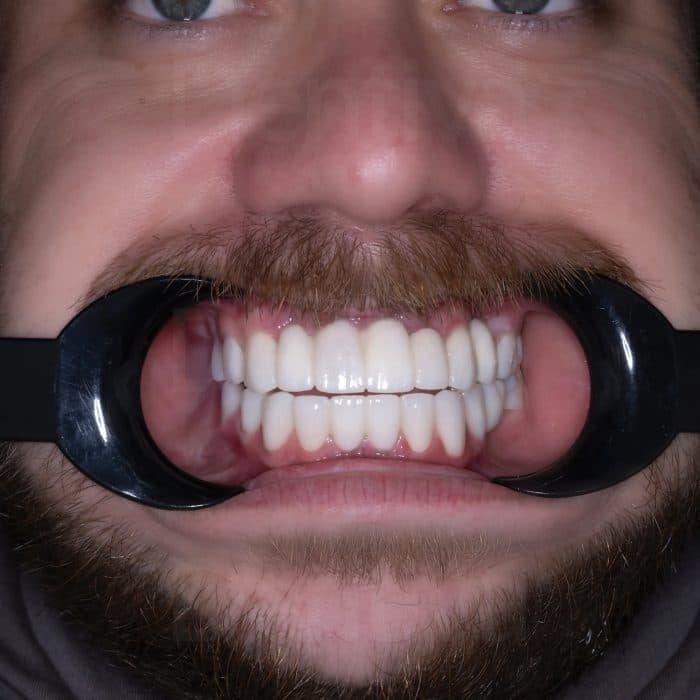 Diş Kronunun Yerleştirilmesi